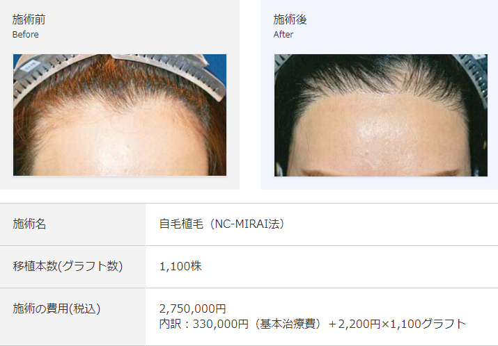ヘアライン矯正と植毛は一緒 あの韓国アイドルも実は受けている 薄毛の治療を始めます ヘアライン矯正と植毛は一緒 あの韓国アイドルも実は受けている 薄毛の治療を始めます
