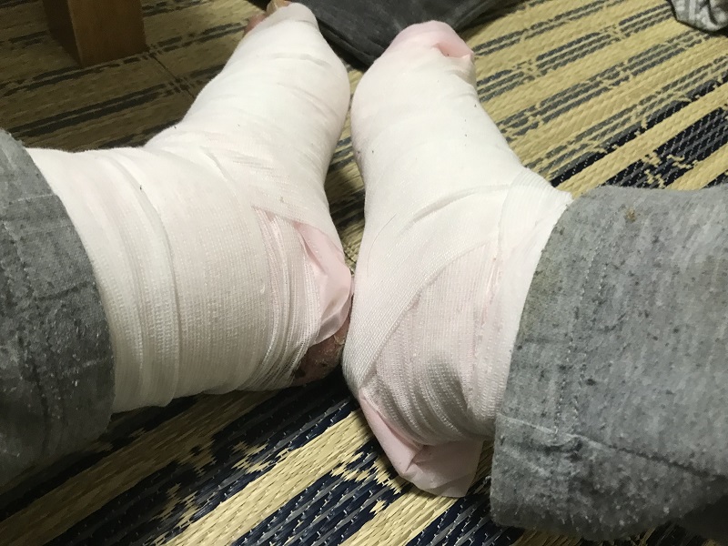 薬疹