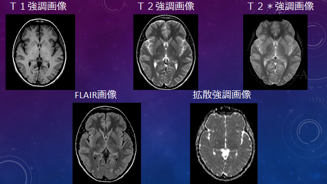 f:id:generalist_physio:20171013225920p:plain