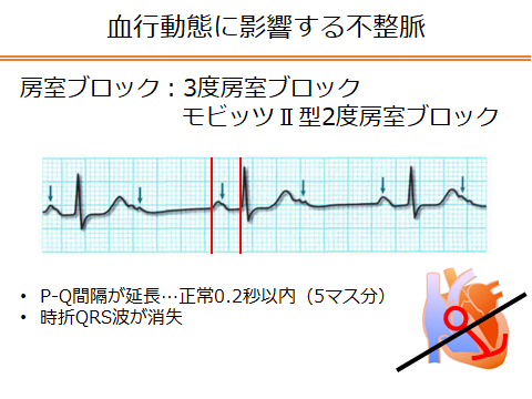 リハビリ中止を検討すべき不整脈 セラピストが知っておきたい臨床知識