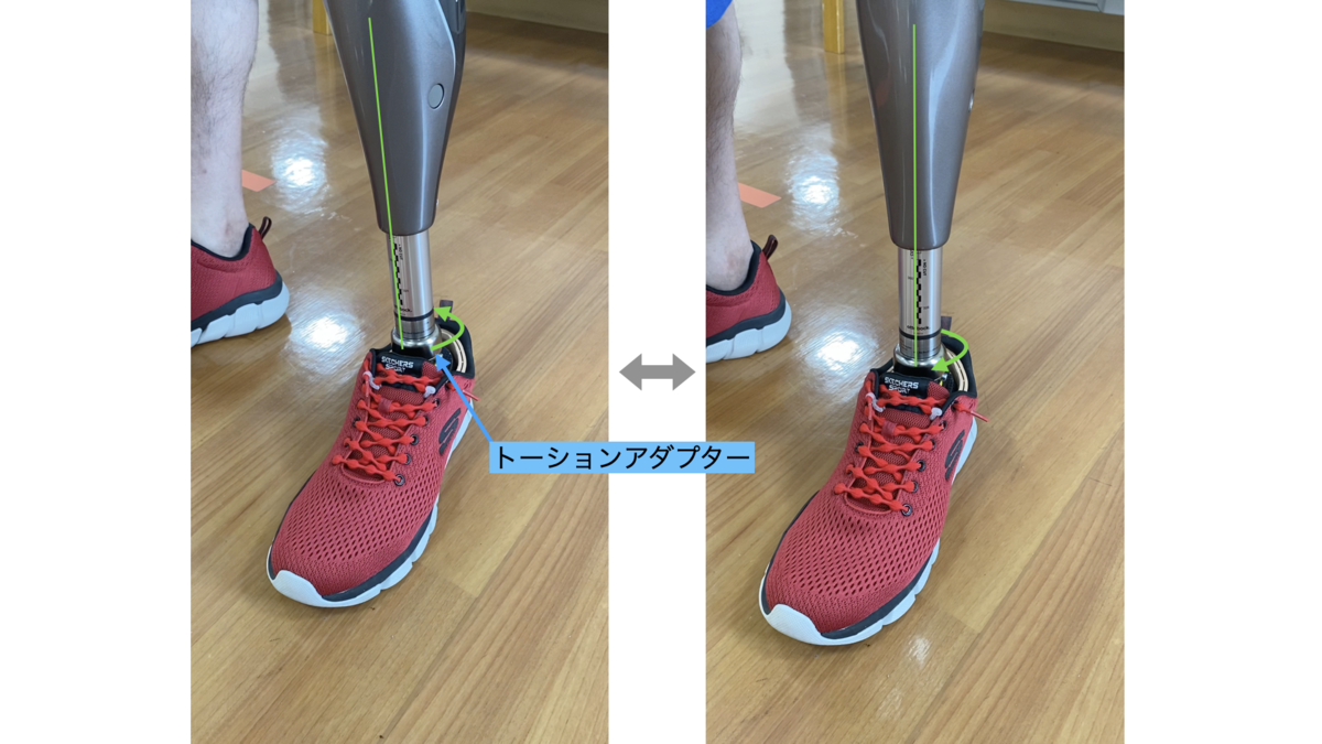 股義足や大腿義足に有用なトーションアダプター - 義足と義手の