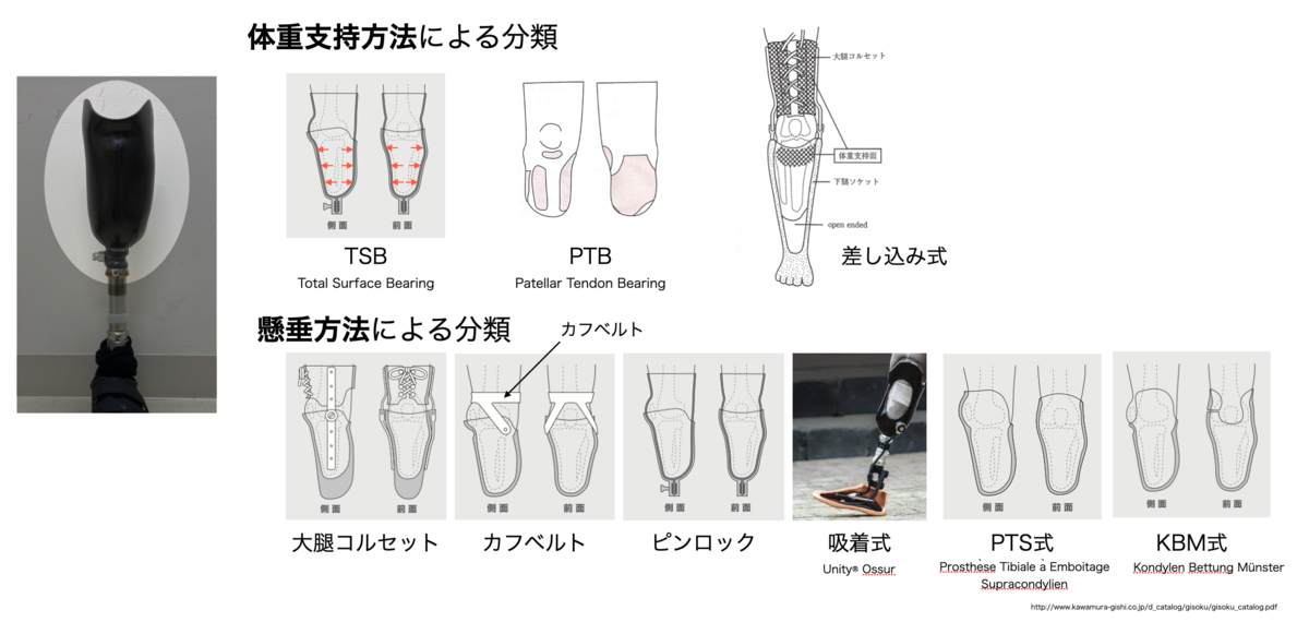 下腿義足ソケットの分類 - 義足と義手のリハビリテーション