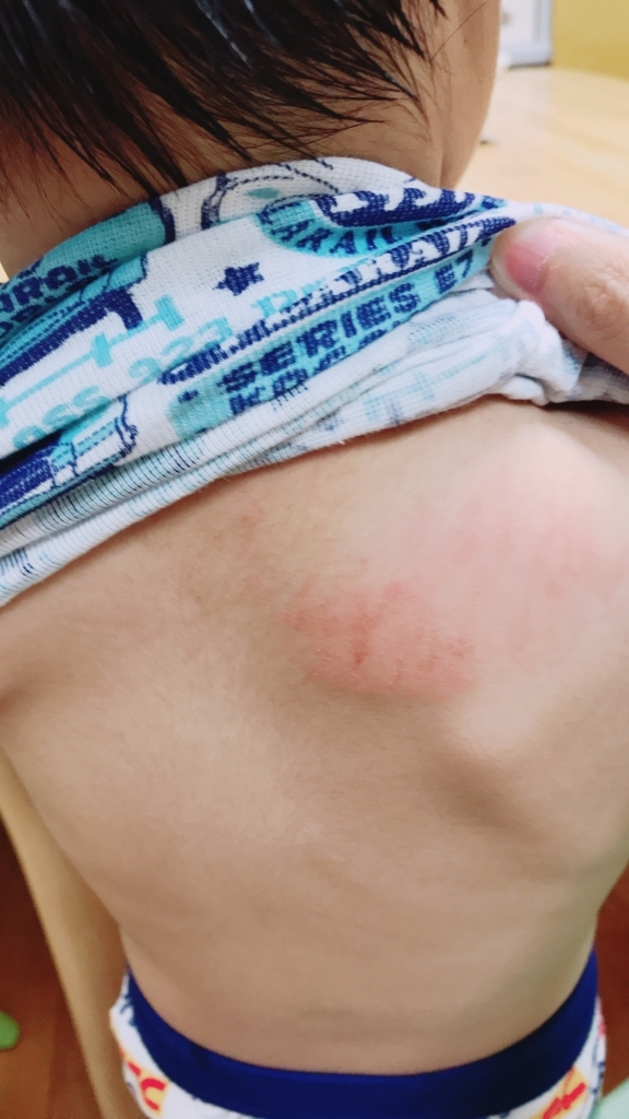 夏バテによる体力低下 蕁麻疹 3歳の子供 働くママのドタバタな毎日 幼児二児を抱えて育休から復帰