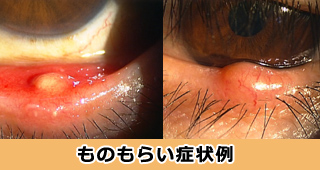 ものもらい 世の中斜めに見なくなったｚっ