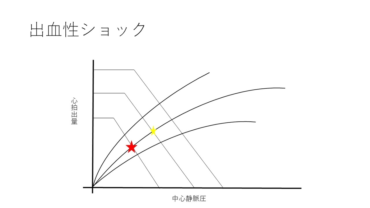 出血性ショック