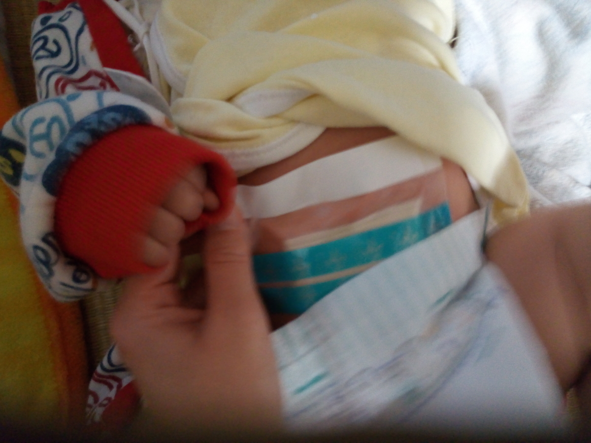 乳児の臍ヘルニアが圧迫療法でついに完治 次男が歩んだ8カ月の通院 Gu Gu Life