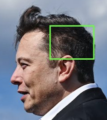 大富豪イーロン・マスクの植毛した「傷あと写真」がコレ。 - ノーネクタイのMy Way