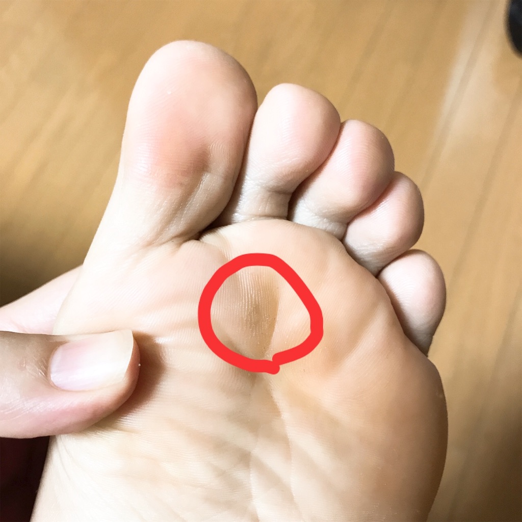 10年間治らなかった足の裏のウイルス性イボを自力で治した話 もち子のブログ 10年間治らなかった足の裏のウイルス性イボを自力で治した話 もち子のブログ