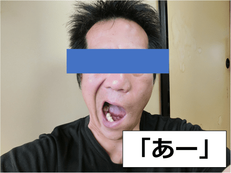 顔面神経麻痺 ベル麻痺 の体験談 原因 治療 費用 治療編2 かげまりずむ 顔面神経麻痺 ベル麻痺 の体験談 原因 治療 費用 治療編2 かげまりずむ