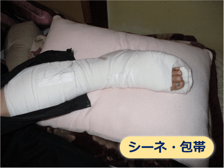 腓骨骨折治療のシーネ固定の様子