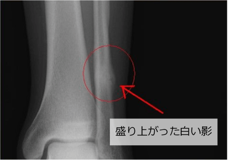 腓骨骨折の仮骨の参考画像