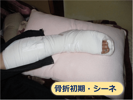 腓骨骨折の女性がシーネを付けている様子