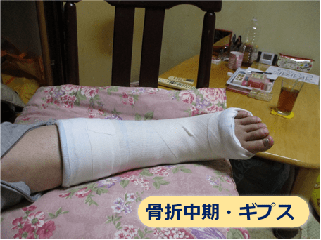 腓骨骨折の女性がギプスを付けている様子