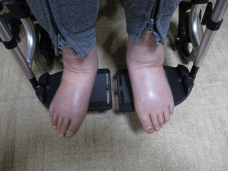 女性の足が両足ともむくんでいる様子