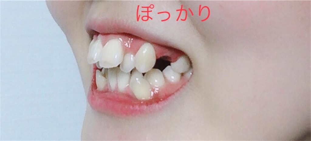 f:id:hanarabi_8020:20201126173207j:image