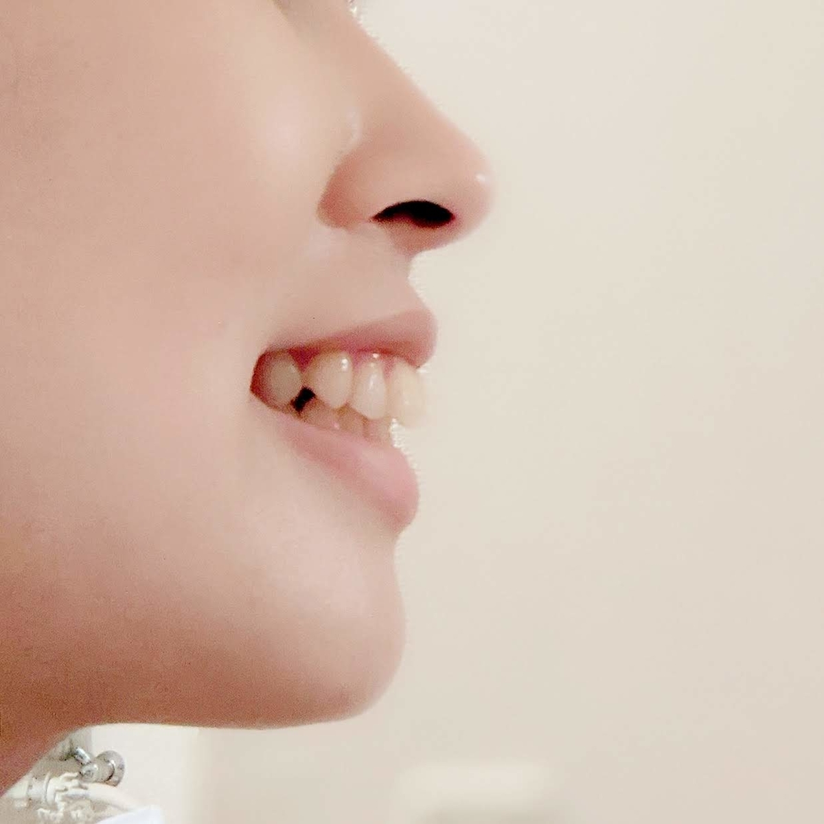 出っ歯の横顔と前歯 ハナラヴィッチ ワルコフの歯列矯正日記