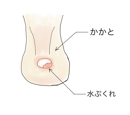 靴擦れによるかかとの水膨れが破れた絵