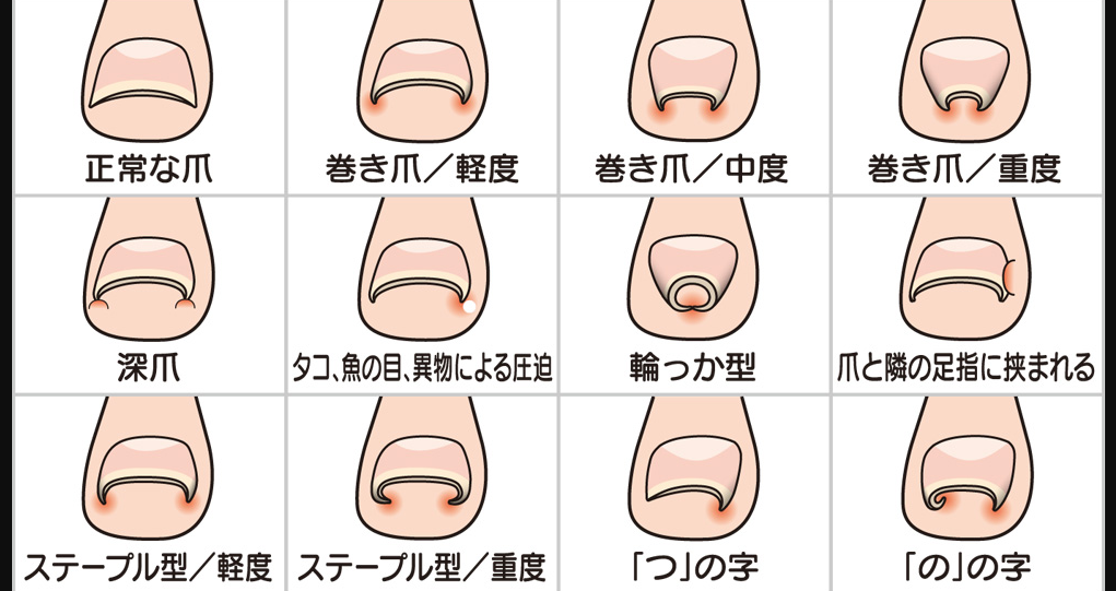 爪 に 現れる 病気 の サイン