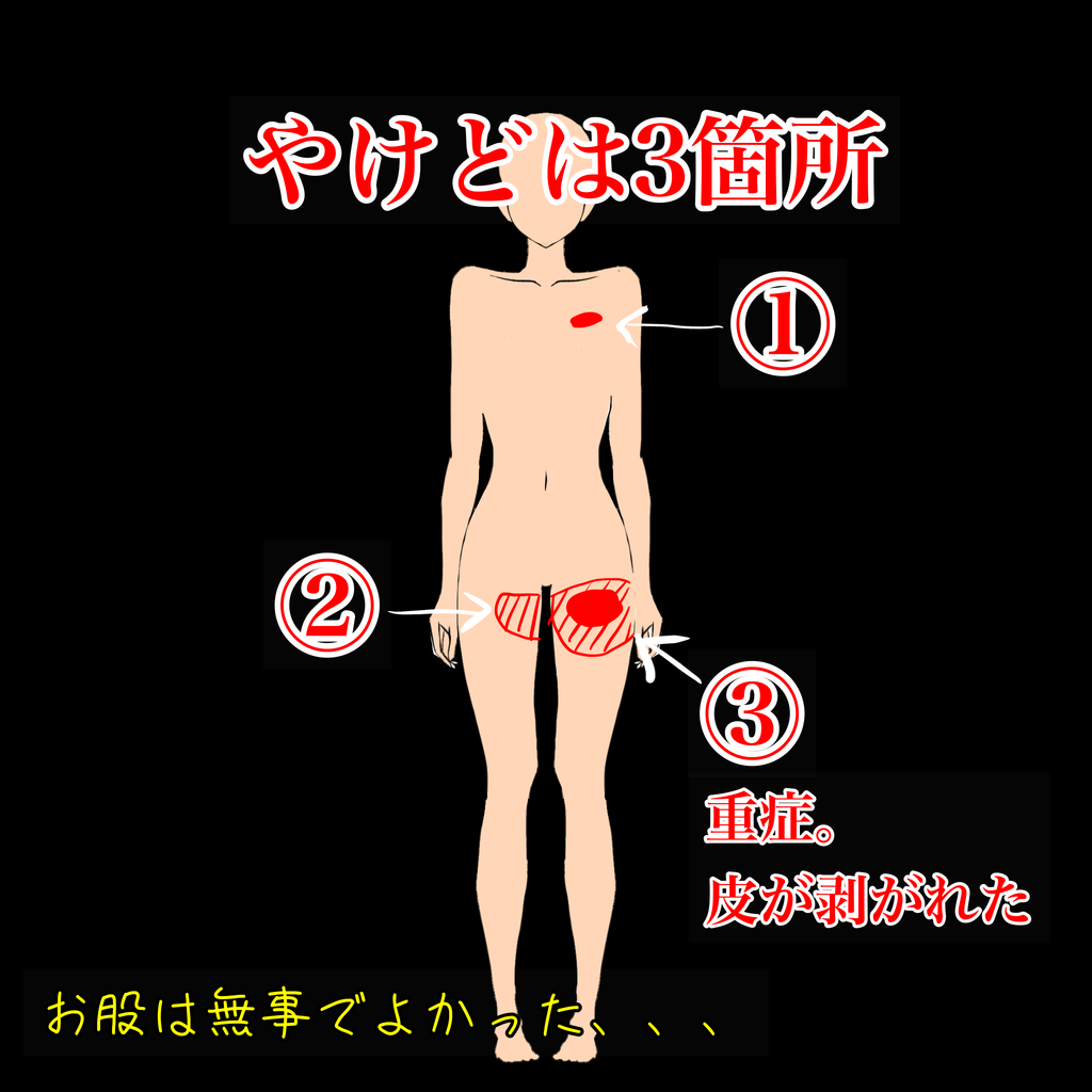 子ども　火傷