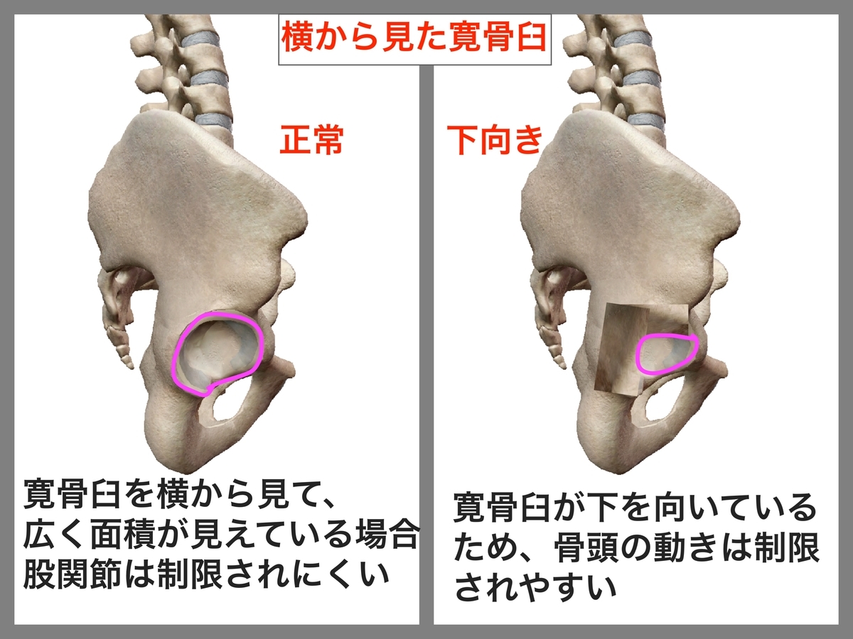 寛骨臼の向きと深さ から考えるスクワットに適した骨格と動きとは トレーニング強化書