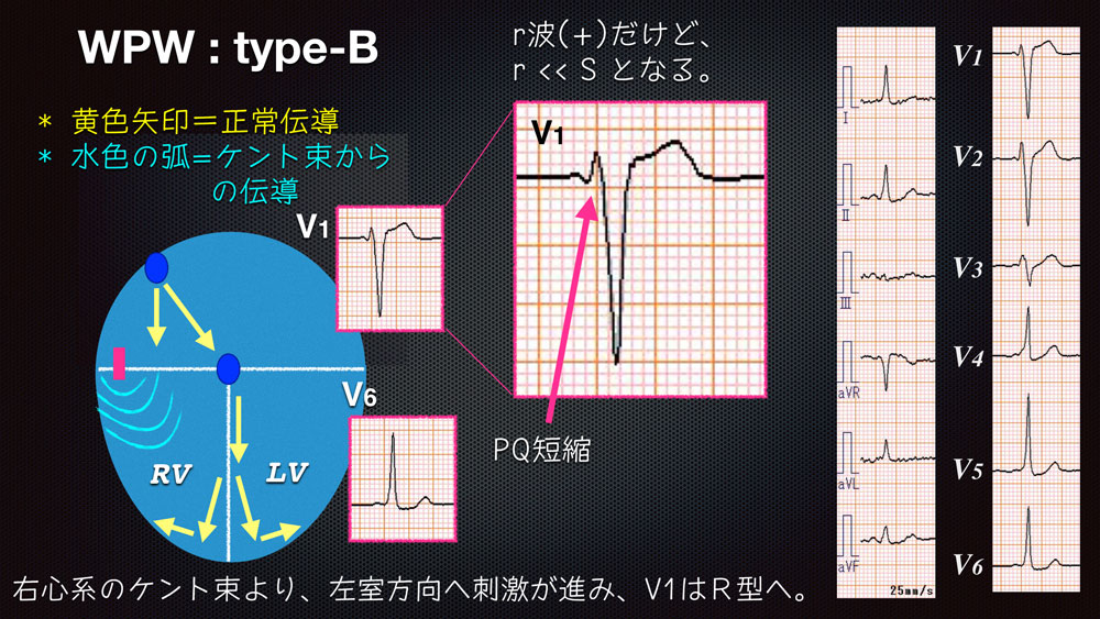 Ecg 354 Answer 2 3 心電図検定試験 傾向と対策 Q 002 Cardio12のecgブログ 19改