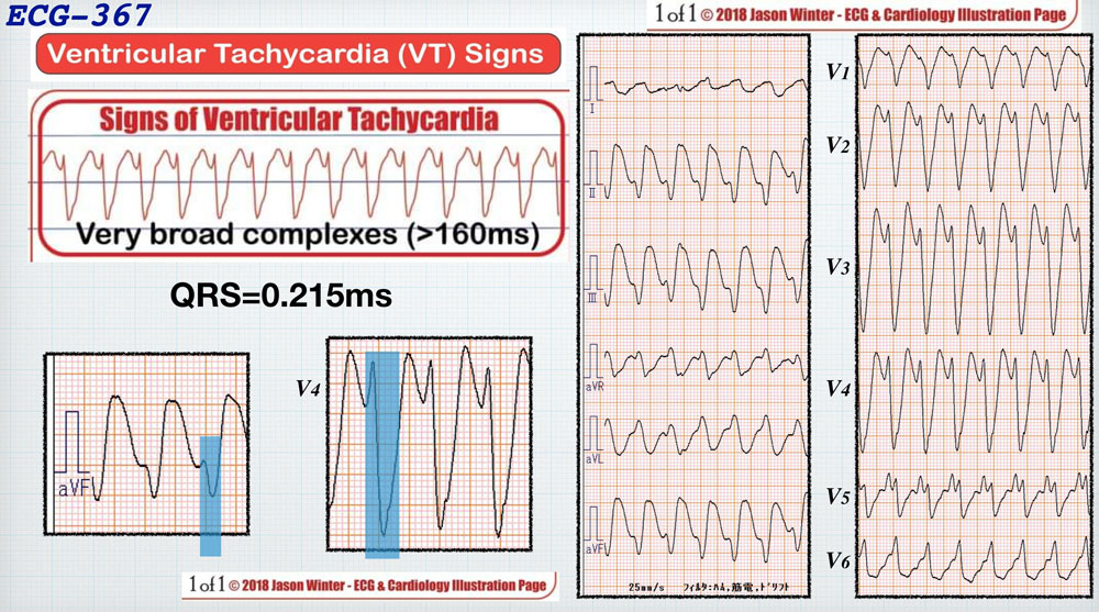 f:id:heart2019:20200311231340j:plain