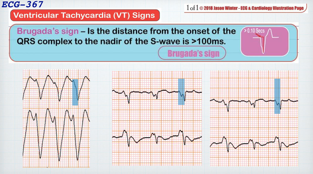 f:id:heart2019:20200311231903j:plain