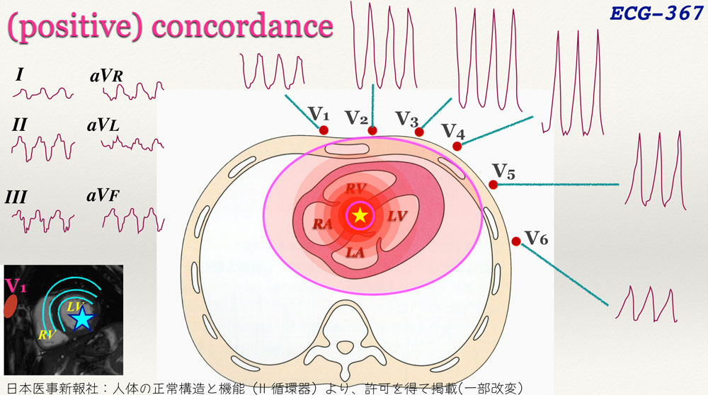 f:id:heart2019:20200312205527j:plain