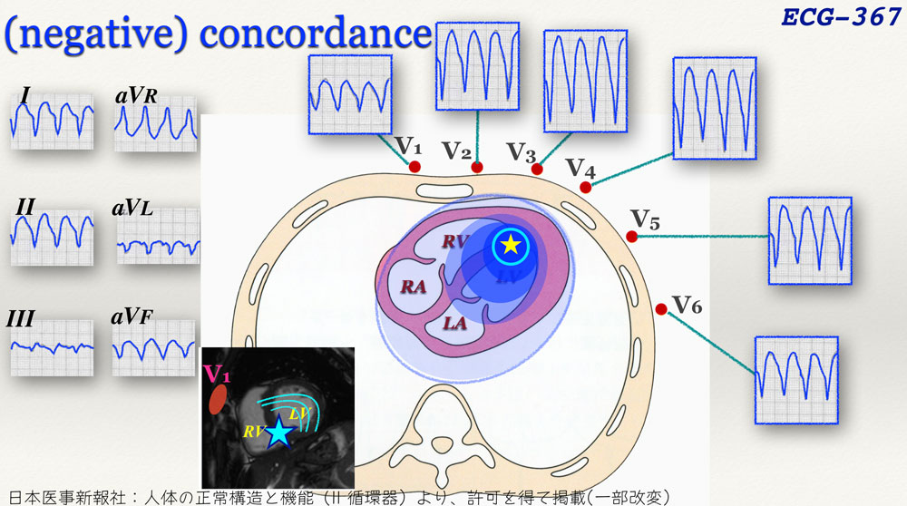 f:id:heart2019:20200312205556j:plain