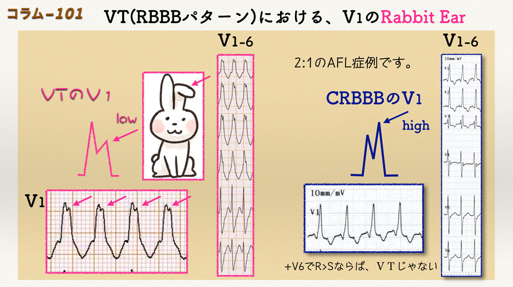 コラム:心電図を説明するイラスト集(freeです)-その3:VT編です。 - Cardio2012のECGブログ-2019改