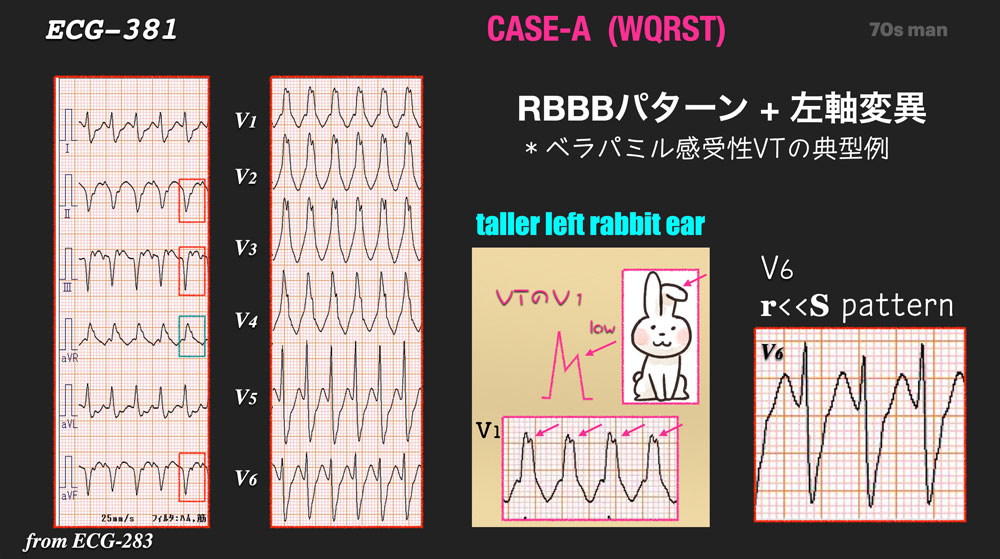 ECG-381: answer VT(1/3) はどれだ? (#心電図検定試験 Question-6) - Cardio2012のECGブログ ...