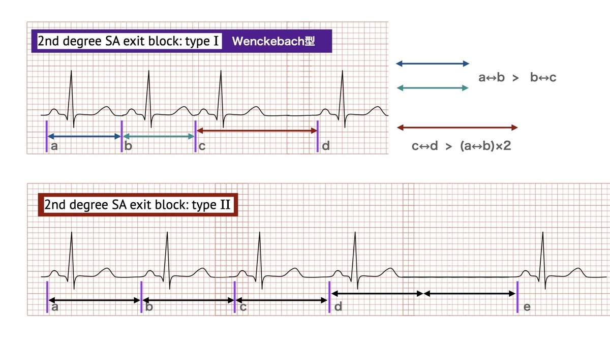 コラム：Sinoatrial exit block Wenckebach type SA block(MobitzI型)。 = 心電図検定