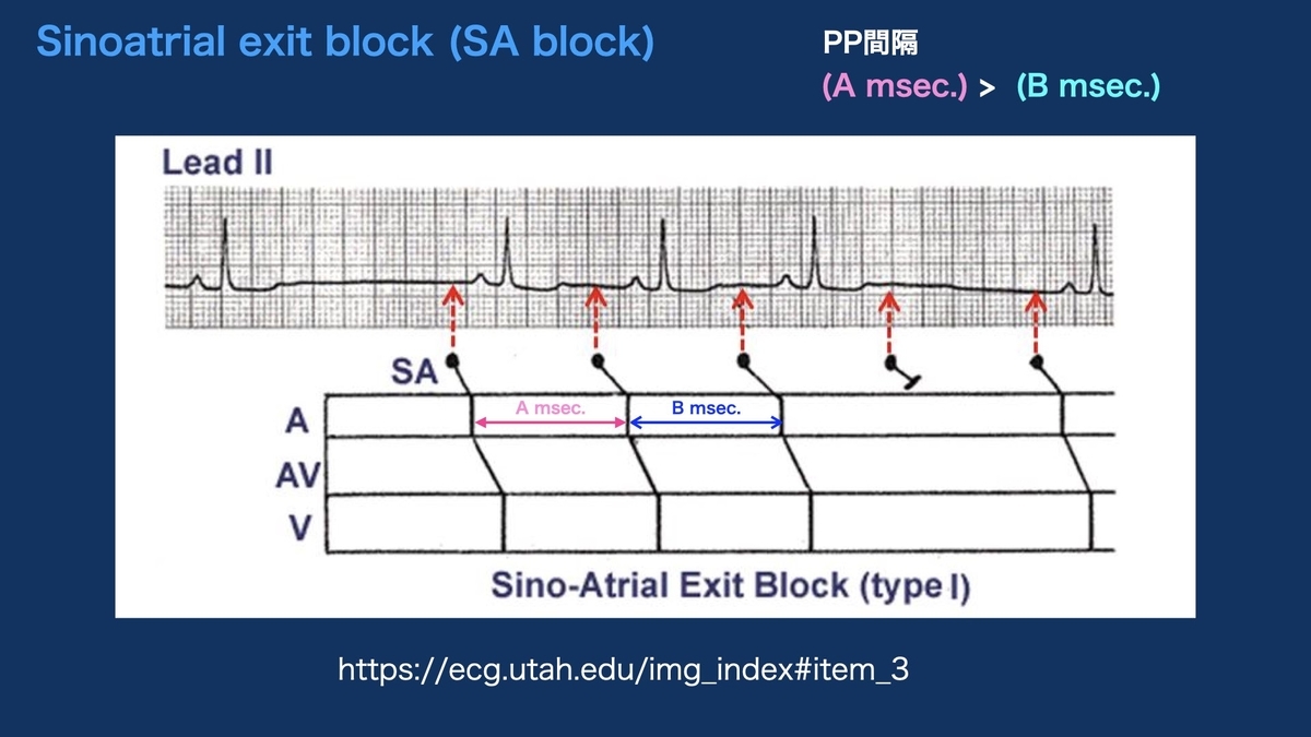 コラム：Sinoatrial exit block Wenckebach type SA block(MobitzI型)。 = 心電図検定