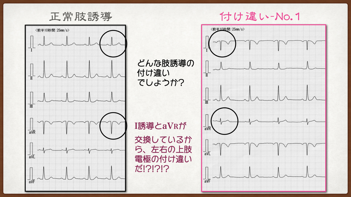 【コラム-140】：ECG Yellow web Book-006-肢誘導の付け違い問題- T-S method-その2】📕→📘→📙 ...