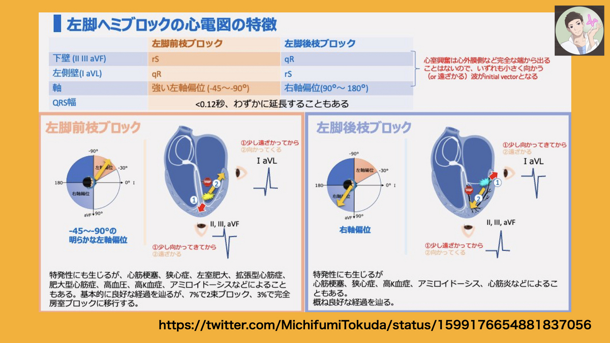 【コラム-156】:徳田道史先生の(ほぼ)画像tweet集です: till 2024/03/17 (#心電図検定試験 対策を含む ...