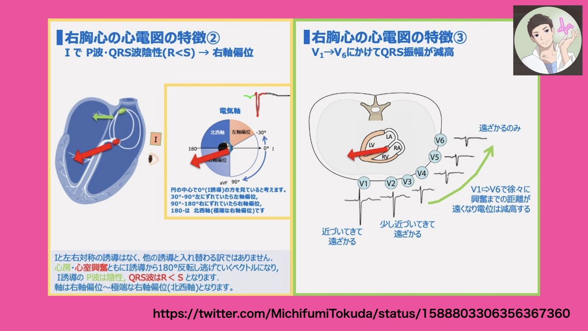 【コラム-156】:徳田道史先生の(ほぼ)画像tweet集です: till 2024/03/17 (#心電図検定試験 対策を含む ...