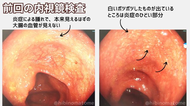 わたしの大腸