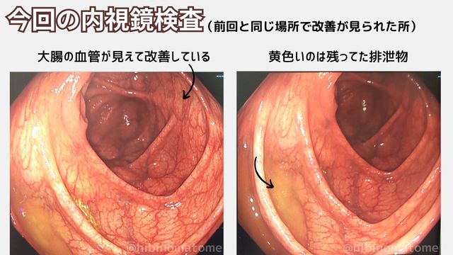 わたしの大腸2