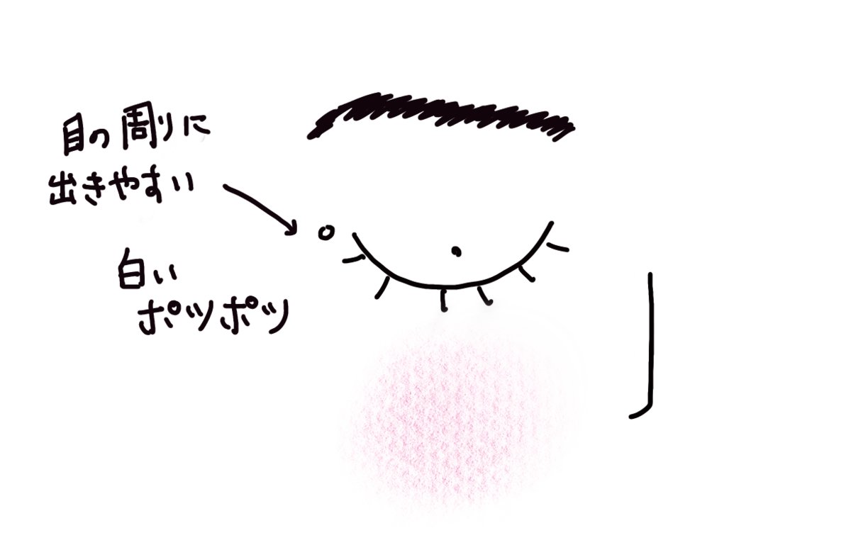 稗粒種を皮膚科で取ってきました 少ないお金ですっきり暮らす