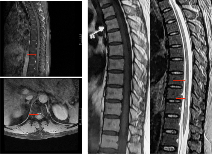 VZV脊髄炎の脊髄MRI:T8〜T11にわたるT2高信号病変と造影効果