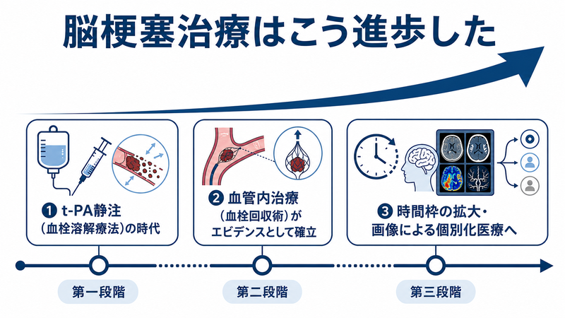 脳梗塞診療の20年を振り返る：tPAから血管内治療、そして個別化医療の