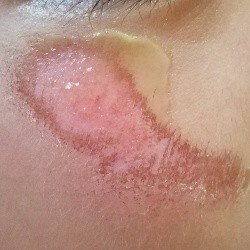 転んだ時の強い味方 擦り傷を消毒しない治療方法 こどものあそび観察日記