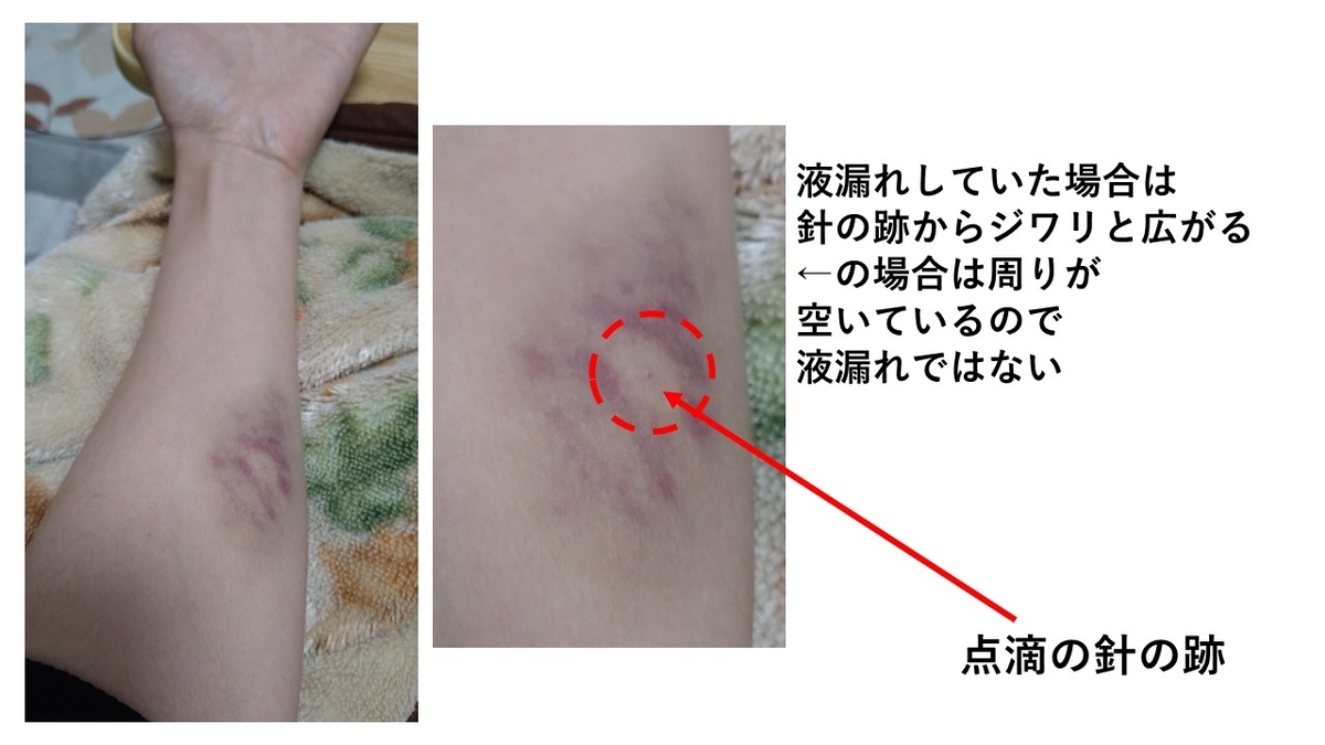 液漏れ 騒動で大空回り 平らかなる闘病記 共病記