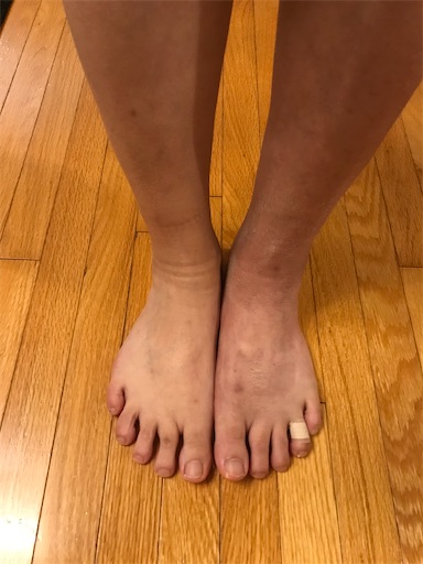アキレス腱断裂術後４週間ギブス外し ヒロコの備忘録