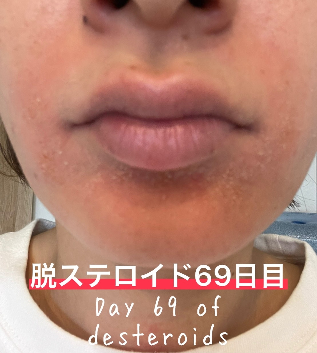脱ステロイド６９日目 口囲皮膚炎 酒さ様皮膚炎の経過報告