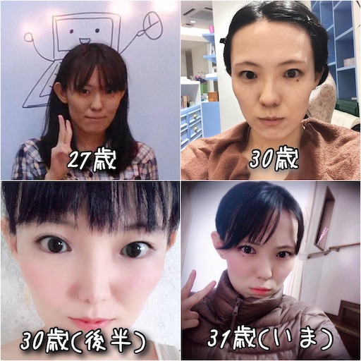 整形 アイプチなし 自力で二重にした方法 30代の美容医療ブログ