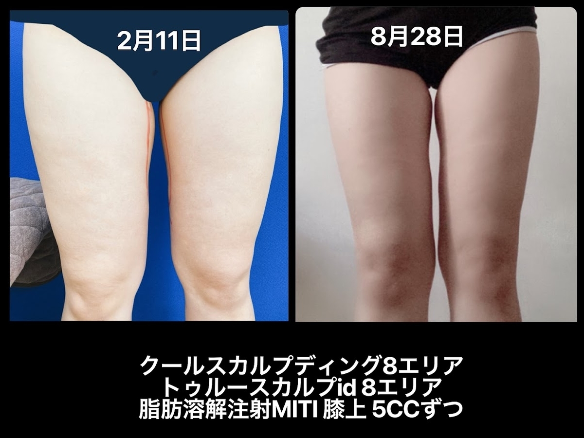 医療ダイエットの脚痩せの結果