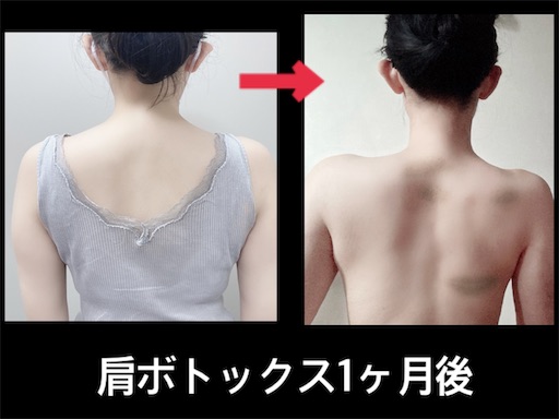 肩ボトックス1か月後