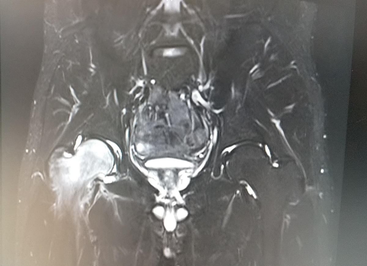 一過性大腿骨頭萎縮症 発症後の経過 Hunmy S Blog
