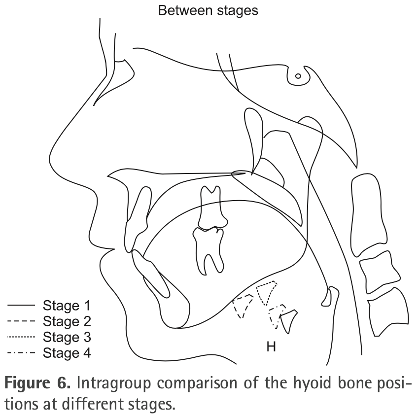 クラスIII不正咬合と嚥下中の舌骨変位との関係:Cine-MRI研究 - huuchiの音楽論文案内